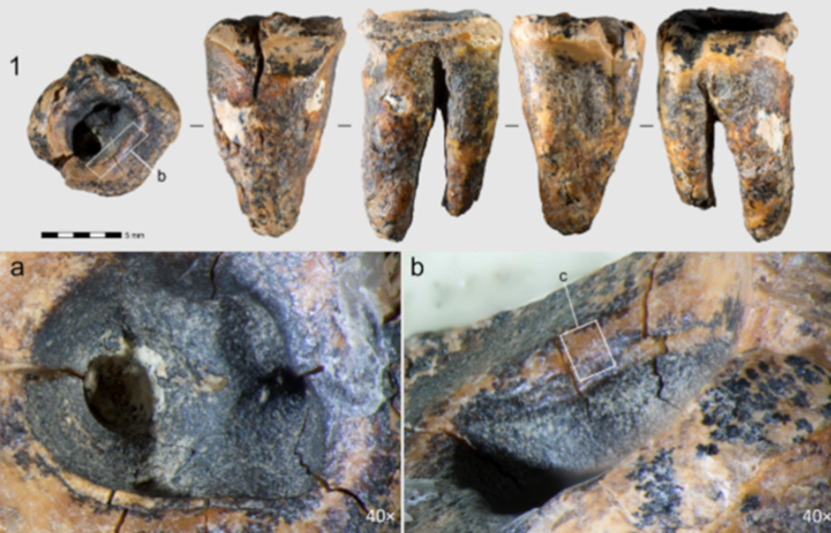 A tooth a Neanderthal tried to fix